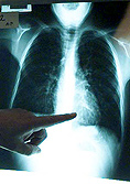 pulmones